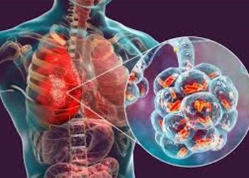 AUMENTAN CASOS DE TUBERCULOSIS EN MÉXICO