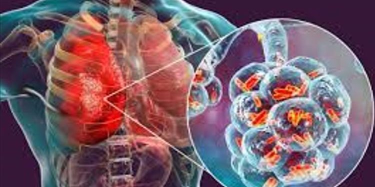 AUMENTAN CASOS DE TUBERCULOSIS EN MÉXICO
